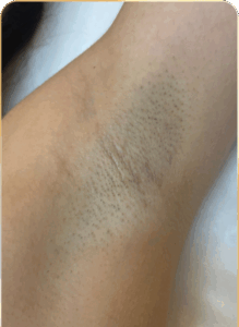 Hónalj terület lézeres szőrtelenítés előtt – természetes szőrnövekedés PrimeLase kezelés megkezdése előtt.