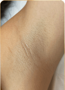 Hónalj terület lézeres szőrtelenítés után PrimeLase kezeléssel – simább bőr és jelentős szőrcsökkenés.