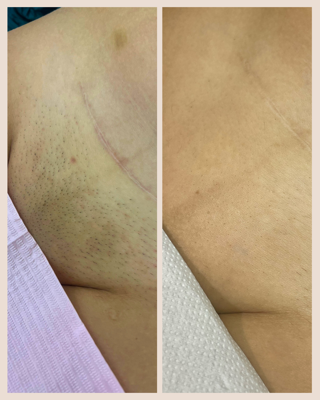 Intimate area laser hair removal – Dramatic before and after results with PrimeLase