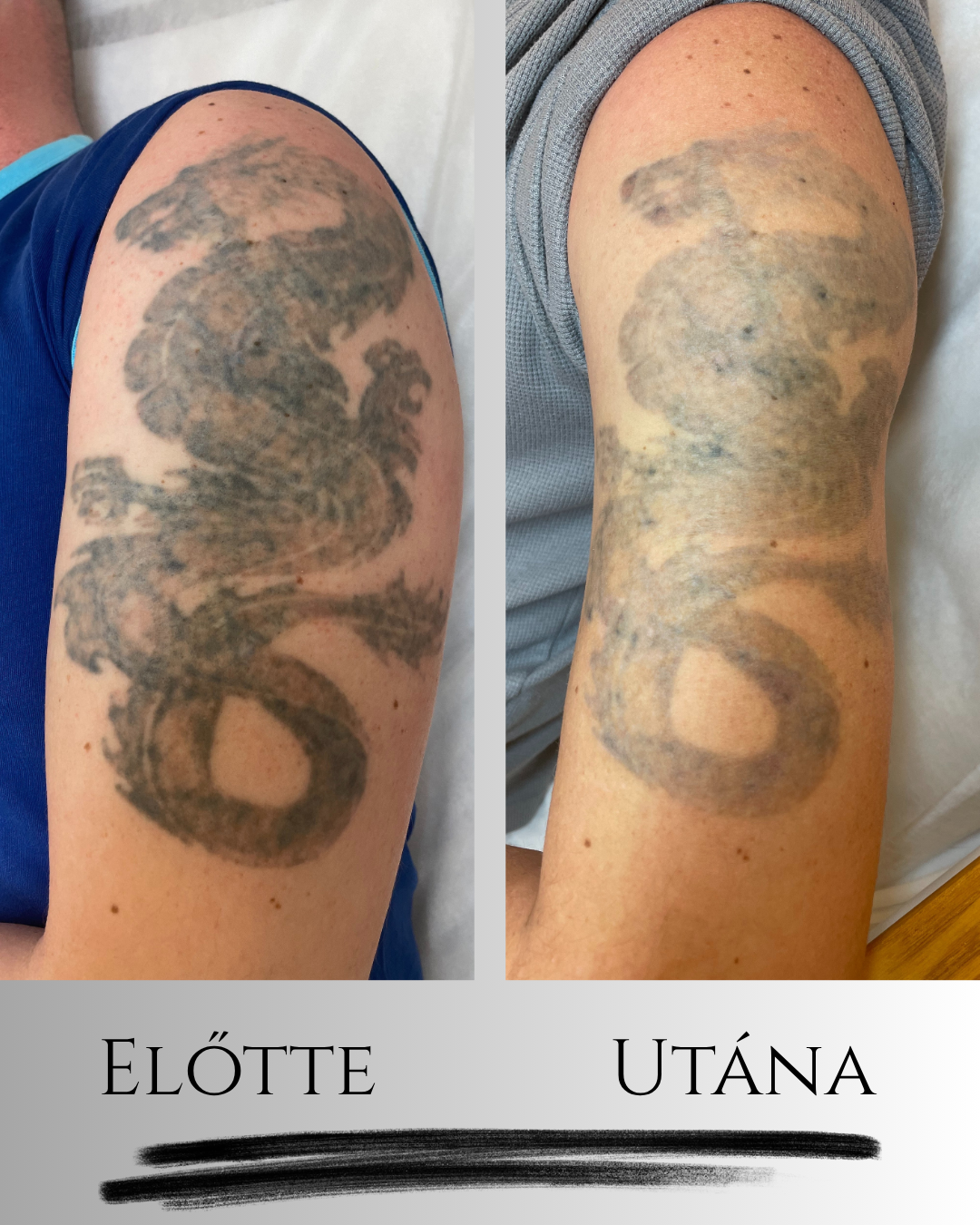 tetoválás eltávolítás_váll_11.16_Instagram Post Lézeres tetoválás eltávolítás előtte–utána kép ND YAG Q-kapcsolt lézerrel, látványos halványodás 2 kezelés után.