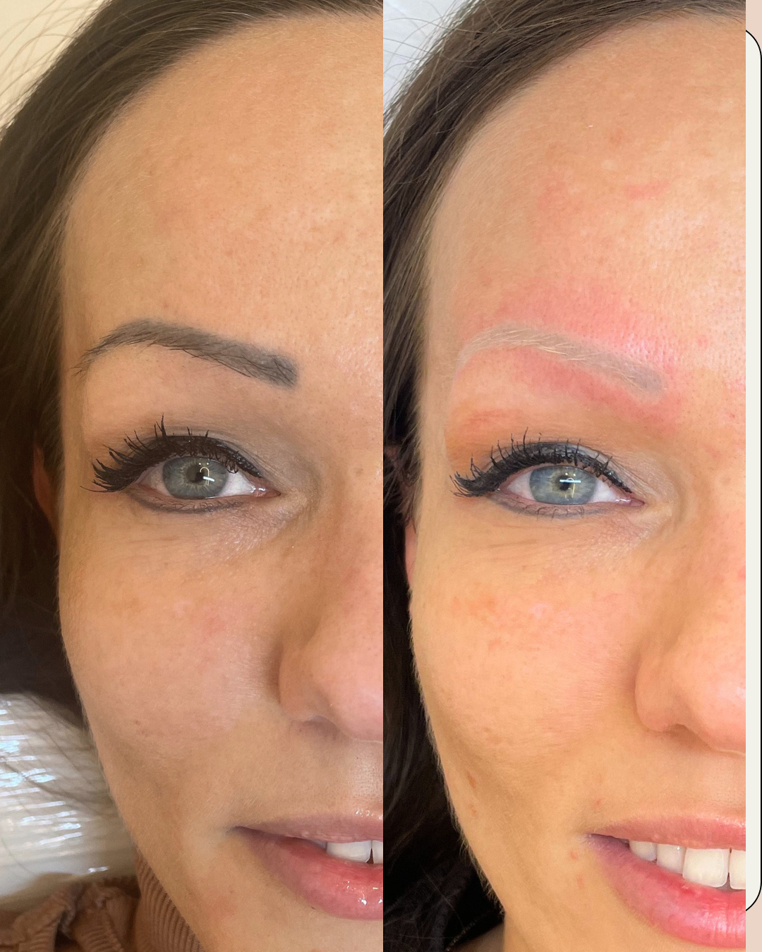 webre_Előtte utána 2 hard lézer.11.20 ND YAG Q-kapcsolt lézeres szemöldök tetoválás eltávolítás – előtte-utána kép női szemöldökről, 2 kezelés után jelentős halványodás és fakulás látható