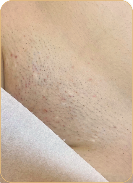 lézeres szőrtelenítés landing oldal előtte kép_intim_03.12 (1) lézeres szőrtelenítés landing oldal előtte kép_intim_03.12