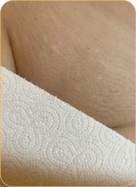 lézeres szőrtelenítés landing oldal utána kép_intim_03.12 lézeres szőrtelenítés landing oldal utána kép_intim_03.12