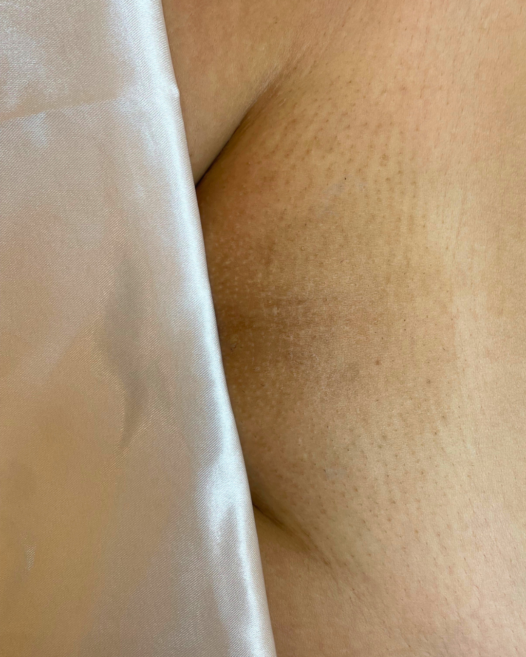 brazilian laser hair removal budapest after