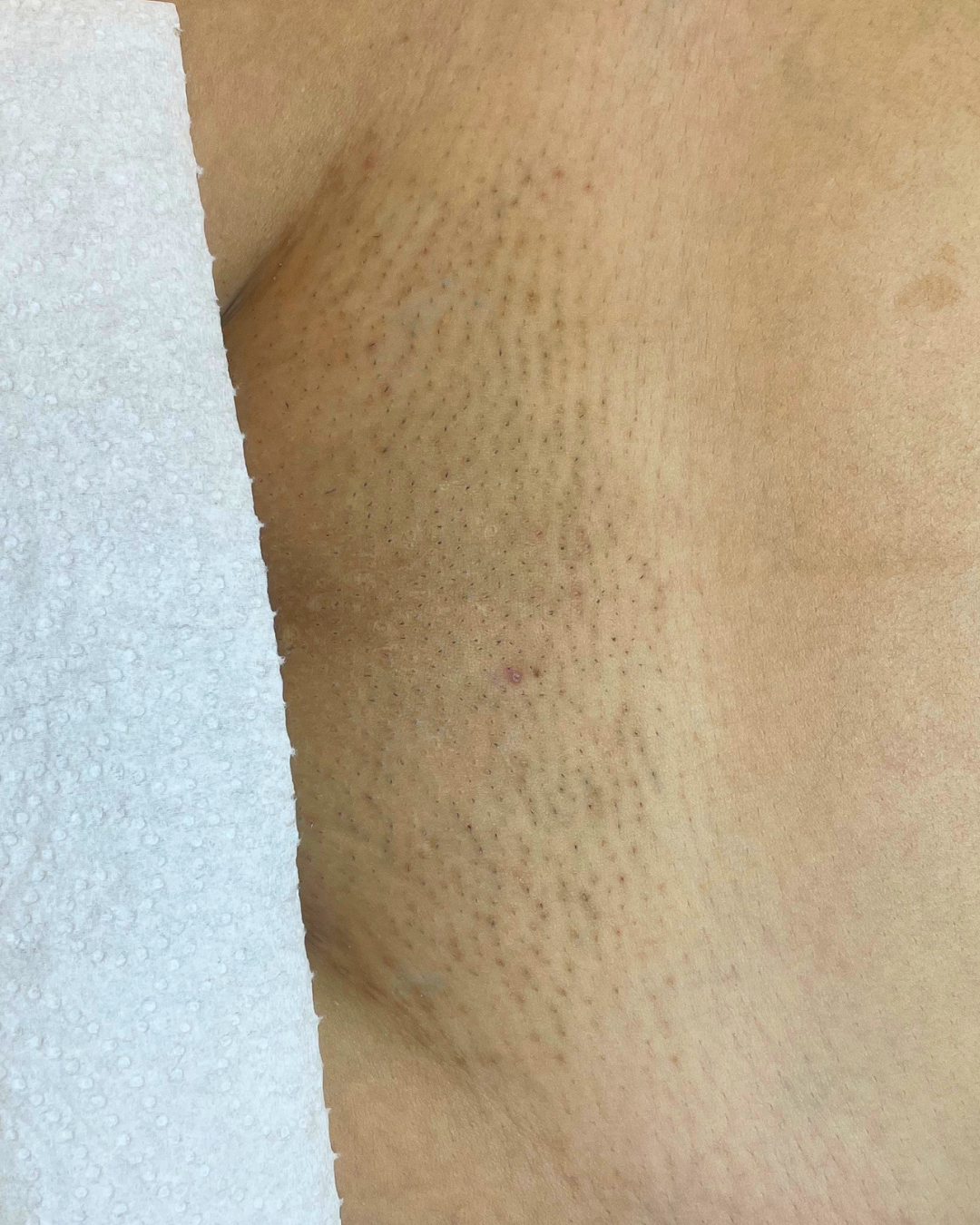 brazilian laser hair removal before