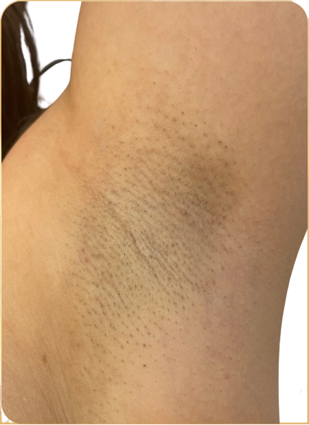 Lézeres szőrtelenítés hónalj területen: előtte-utána fotó, NB Beauty Budapest.