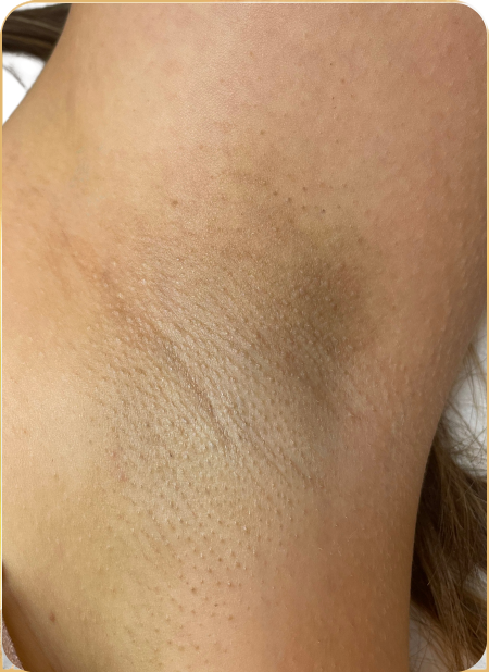 Lézeres szőrtelenítés hónalj területen, kezelés utáni állapot – NB Beauty Budapest.